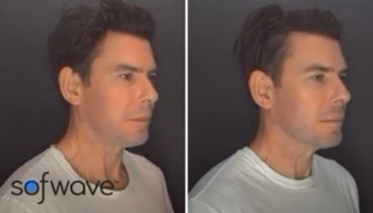 Dr. Gregory Mueller's Sofwave™ Patient For Fine Lines And Wrinkles Dr. Gregory Mueller's Sofwave™ Patient For Fine Lines And Wrinkles