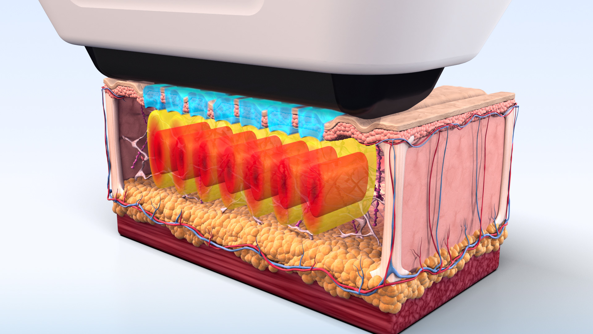 Sofwave MOA Sofwave MOA